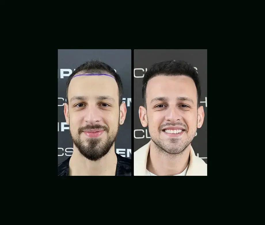 emphair-hair-transplant-before-after-1