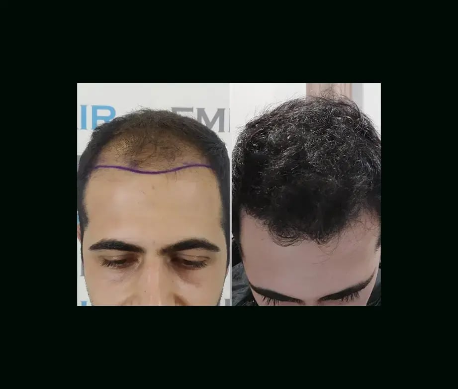 emphair-hair-transplant-before-after-10