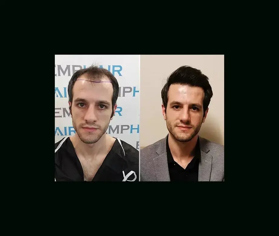 emphair-hair-transplant-before-after-11