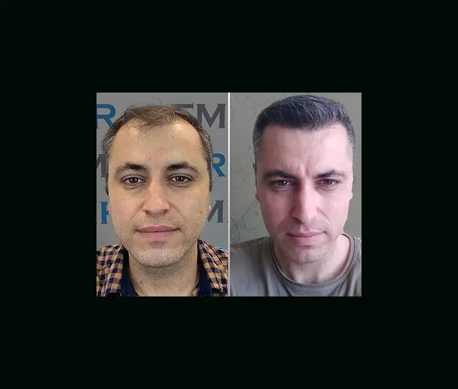 emphair-hair-transplant-before-after-12