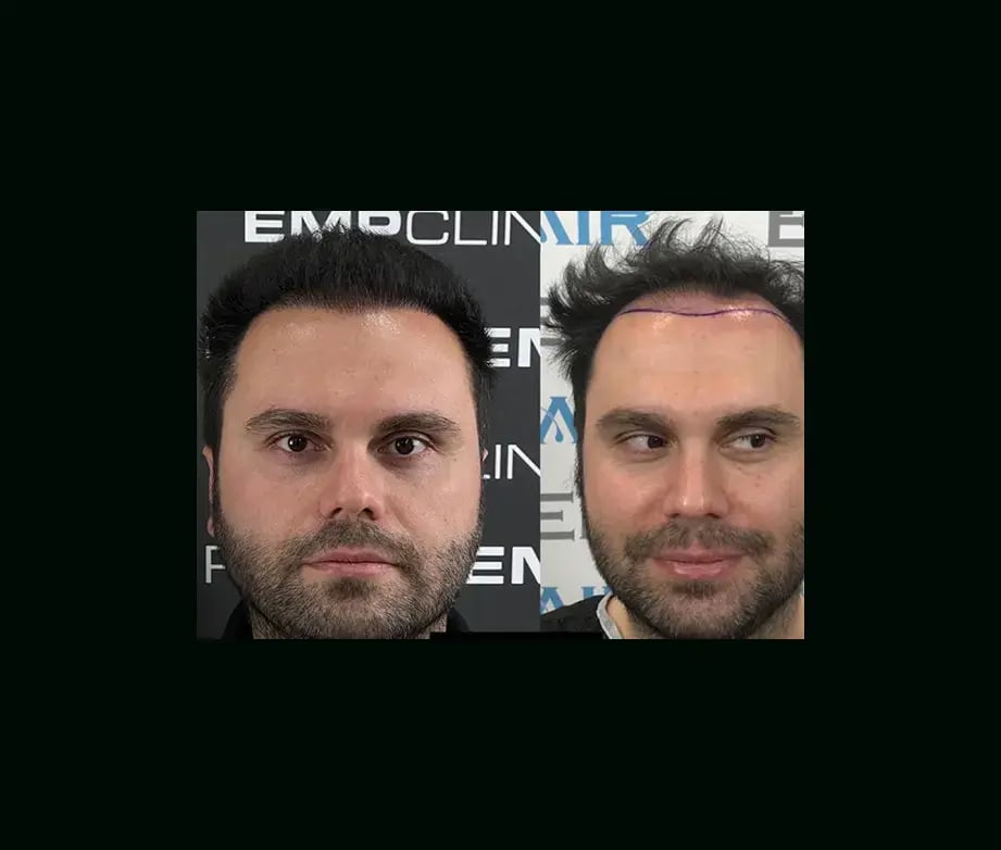 emphair-hair-transplant-before-after-13