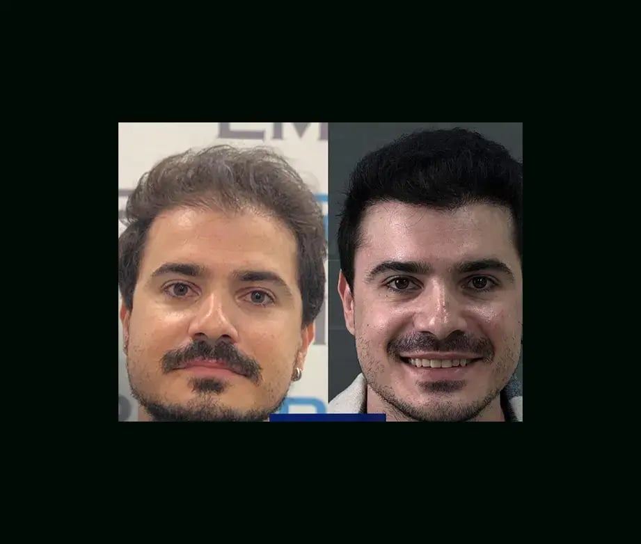 emphair-hair-transplant-before-after-14