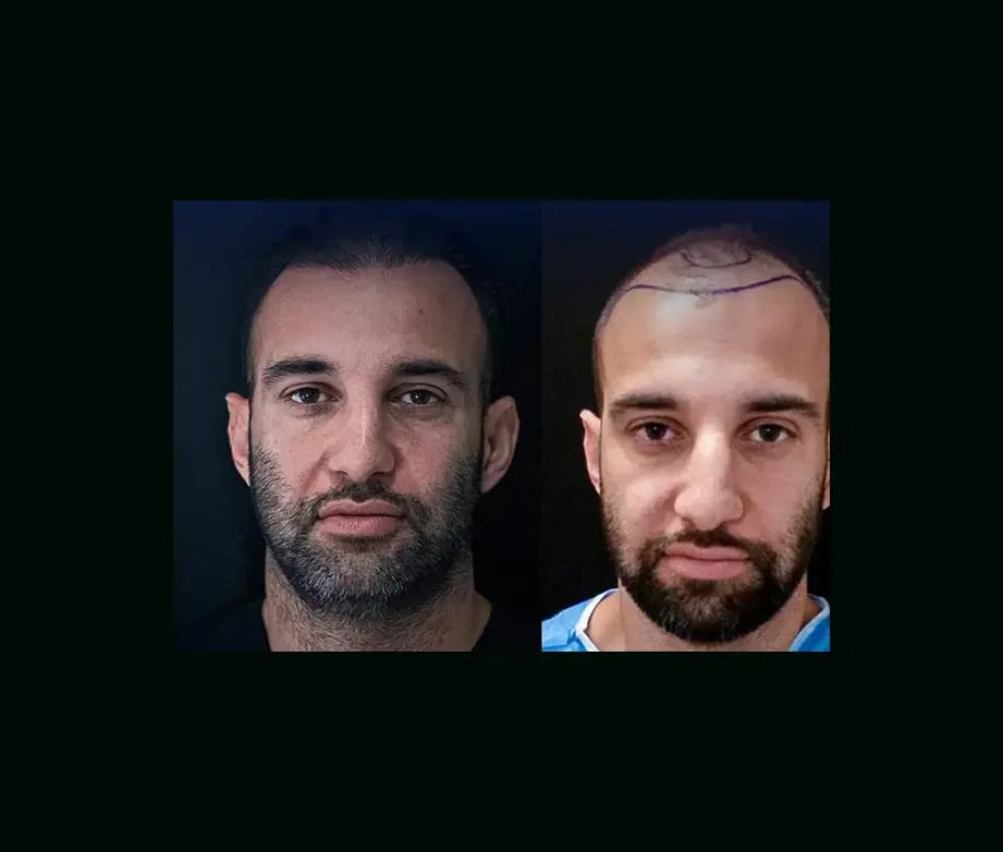 emphair-hair-transplant-before-after-15