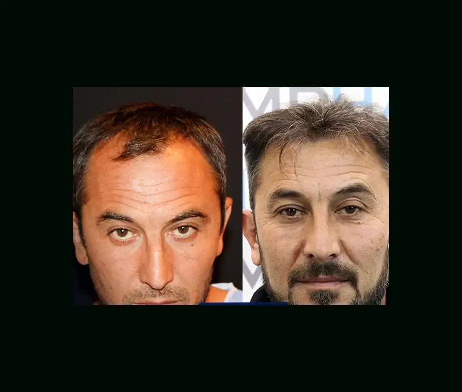 emphair-hair-transplant-before-after-16