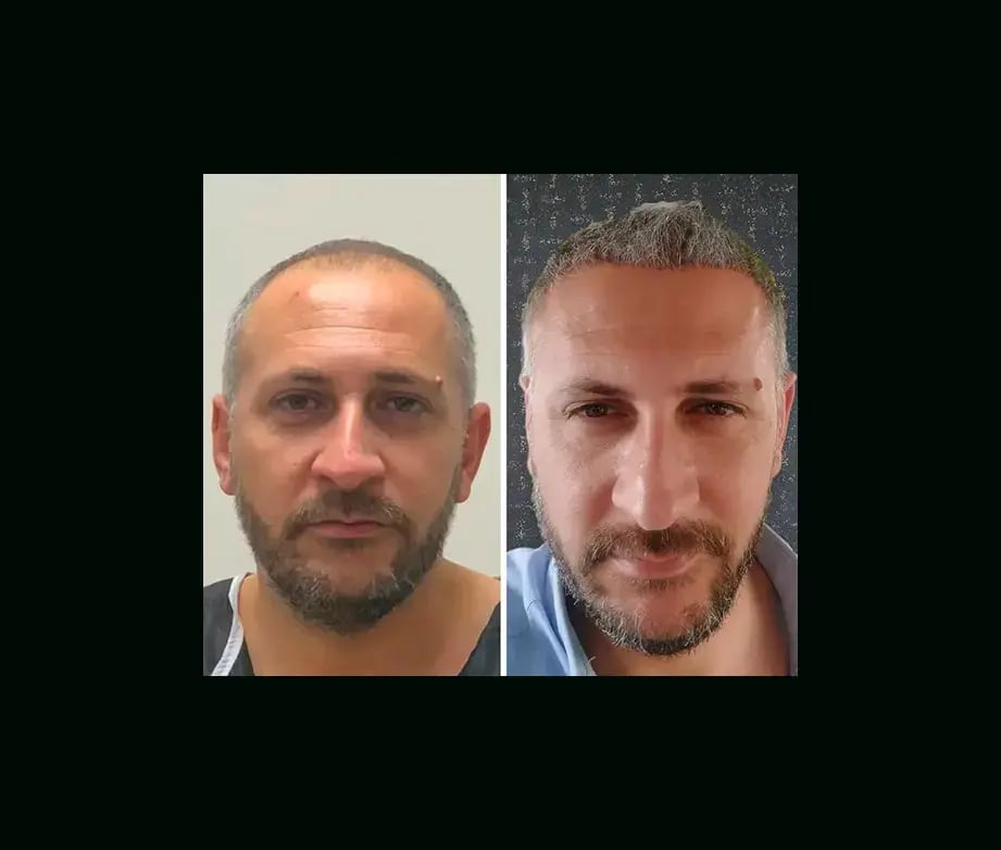emphair-hair-transplant-before-after-17