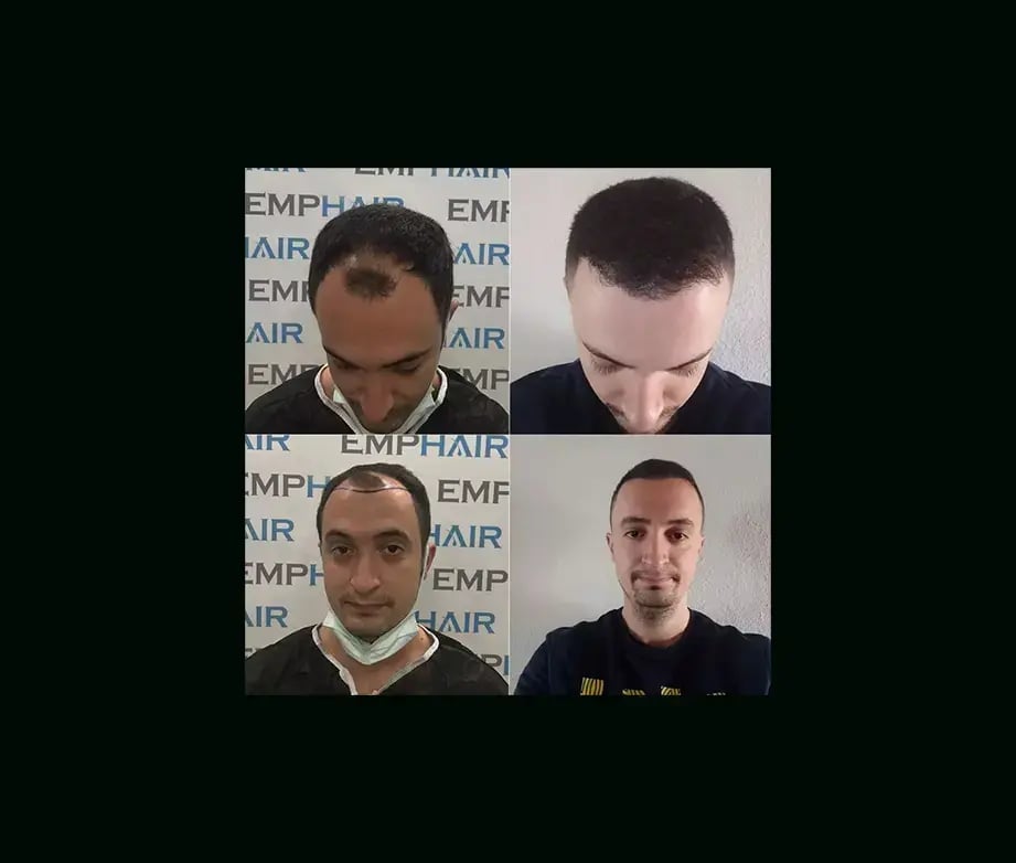 emphair-hair-transplant-before-after-18