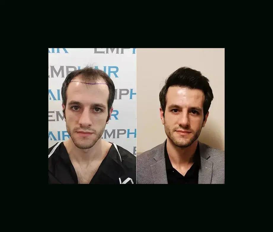 emphair-hair-transplant-before-after-19