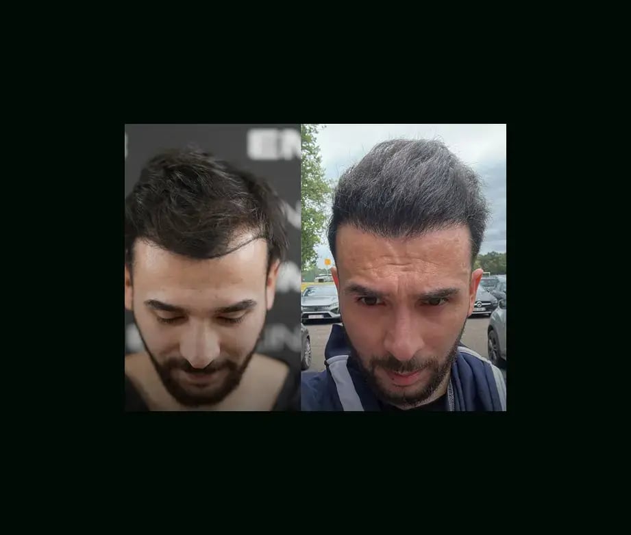 emphair-hair-transplant-before-after-2