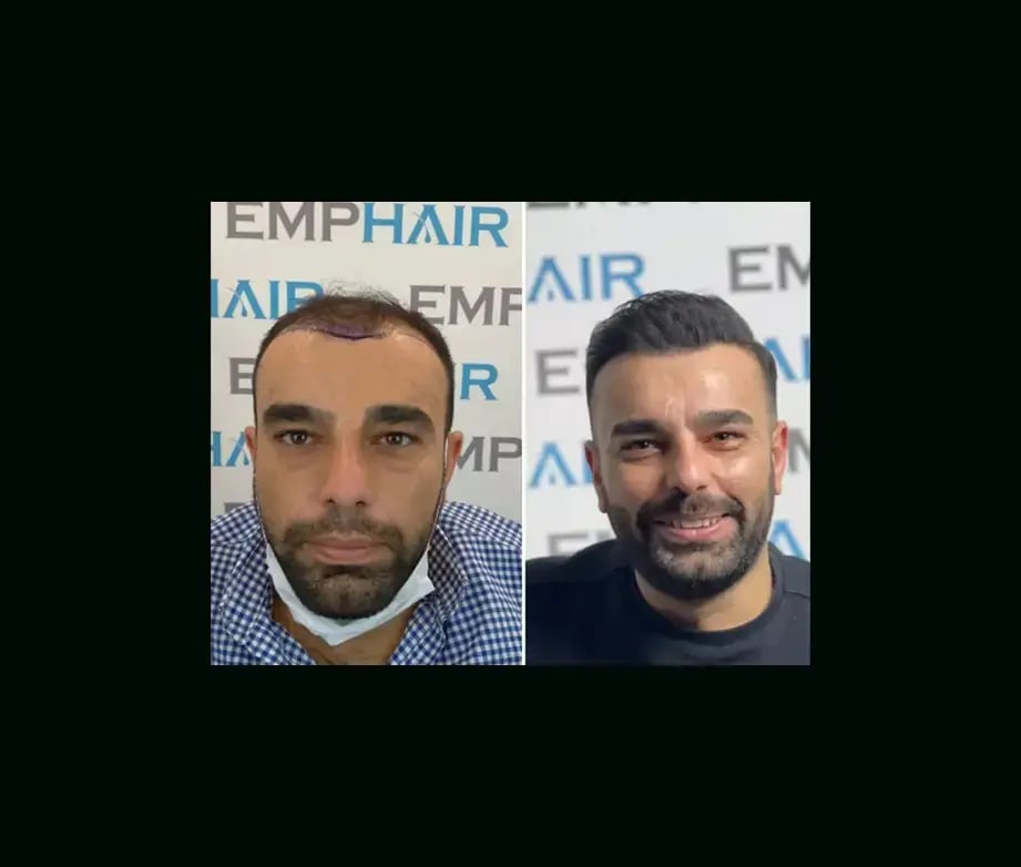 emphair-hair-transplant-before-after-20