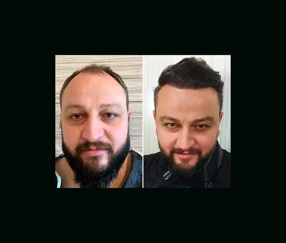 emphair-hair-transplant-before-after-21