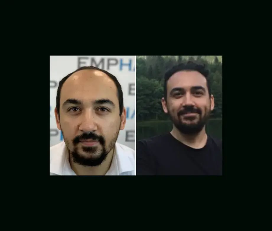 emphair-hair-transplant-before-after-22