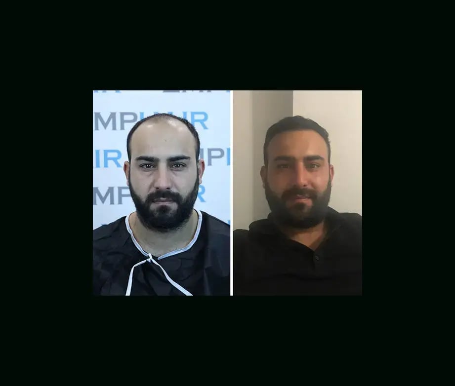emphair-hair-transplant-before-after-23
