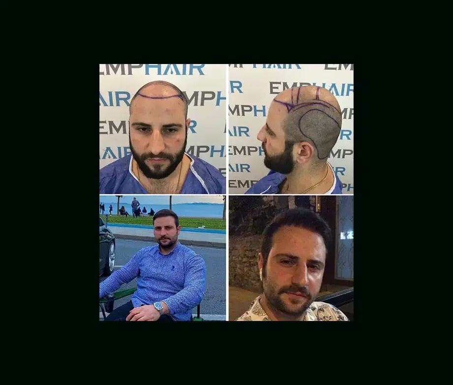 emphair-hair-transplant-before-after-24