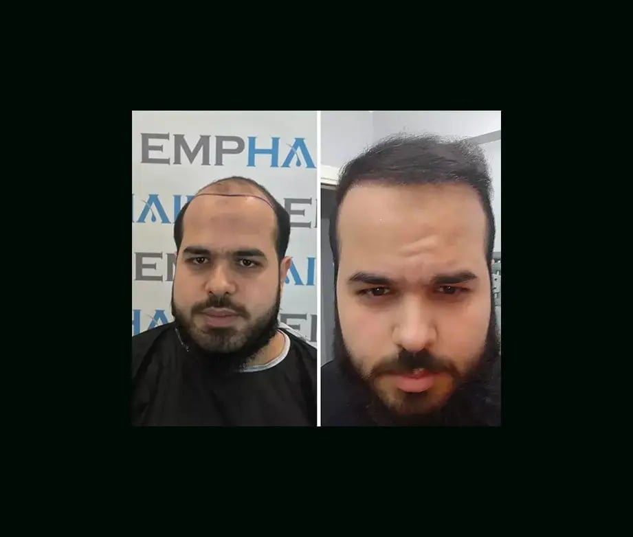 emphair-hair-transplant-before-after-25