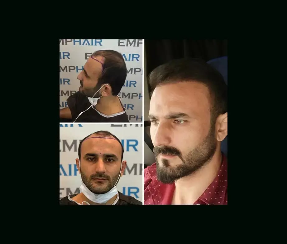 emphair-hair-transplant-before-after-26