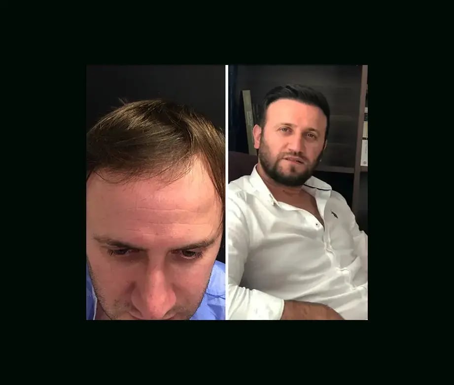 emphair-hair-transplant-before-after-27