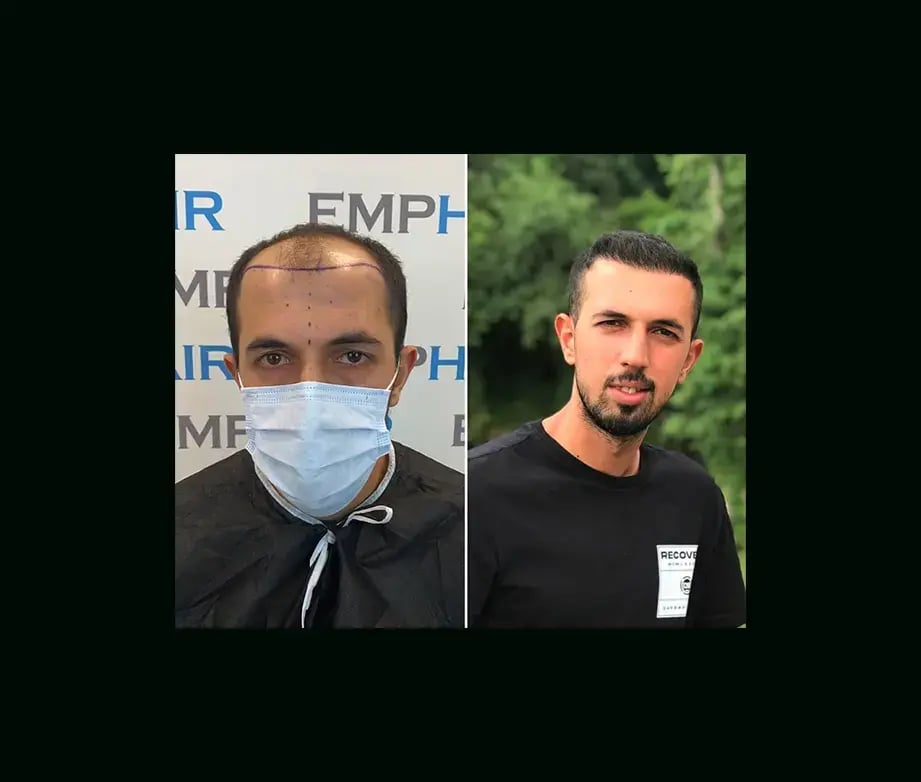 emphair-hair-transplant-before-after-28