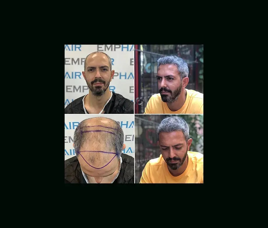 emphair-hair-transplant-before-after-29