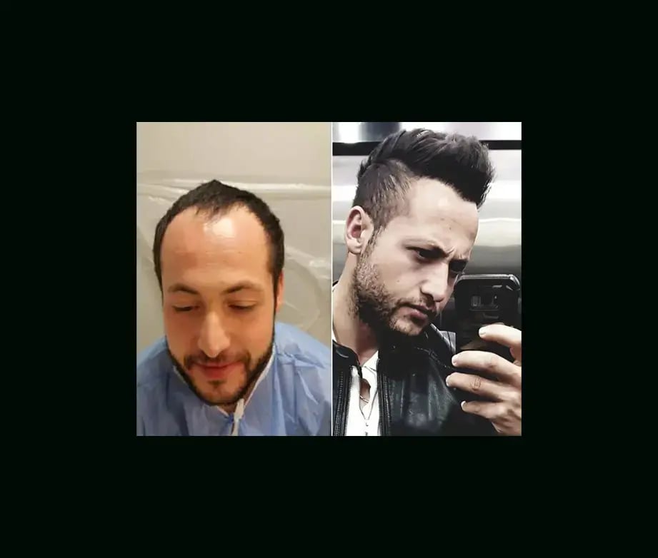 emphair-hair-transplant-before-after-3