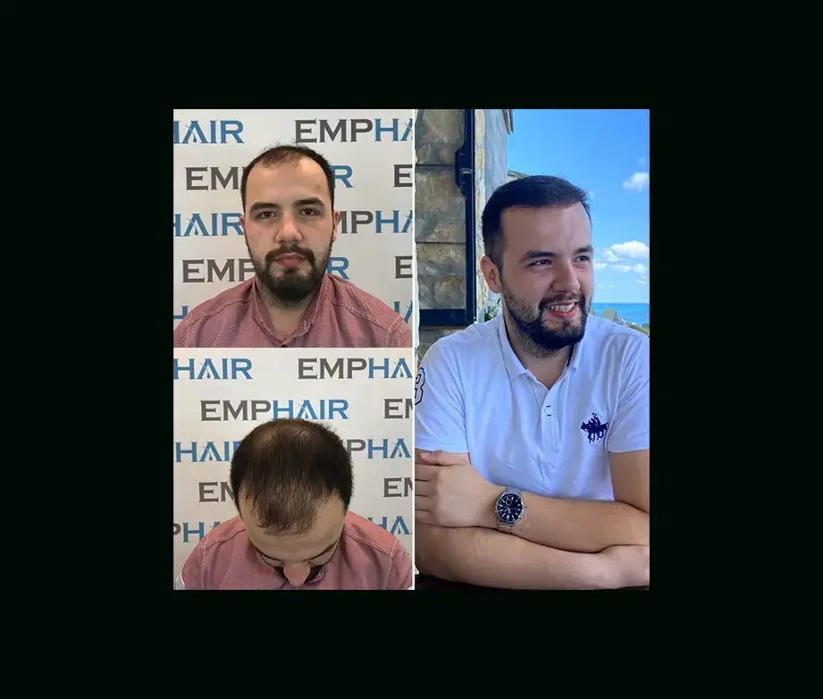 emphair-hair-transplant-before-after-30