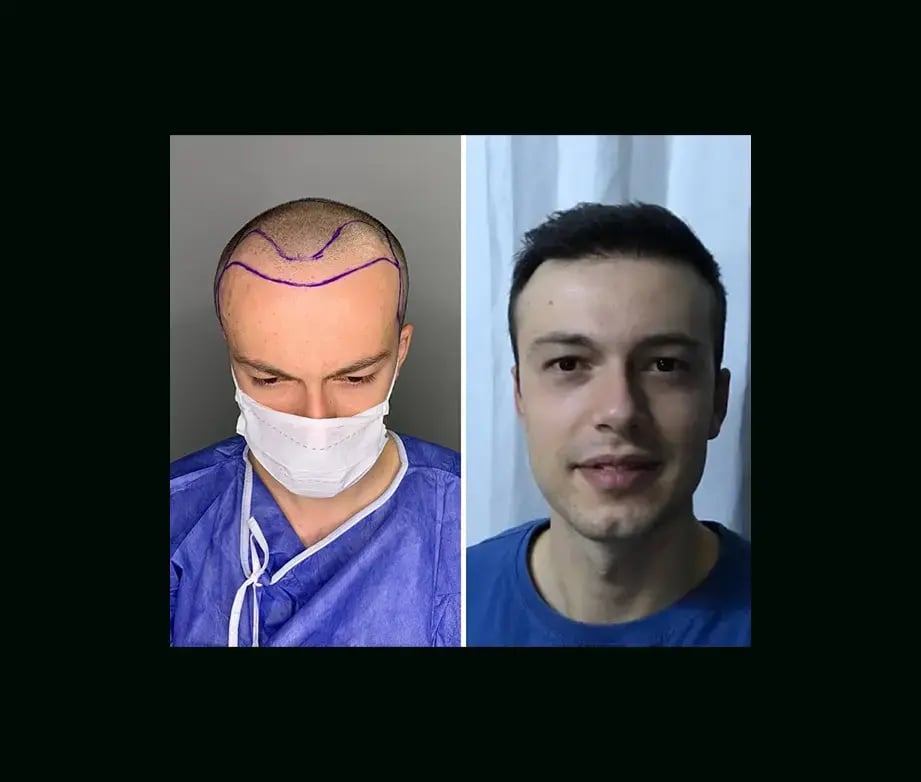 emphair-hair-transplant-before-after-31