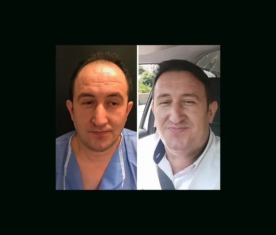 emphair-hair-transplant-before-after-32