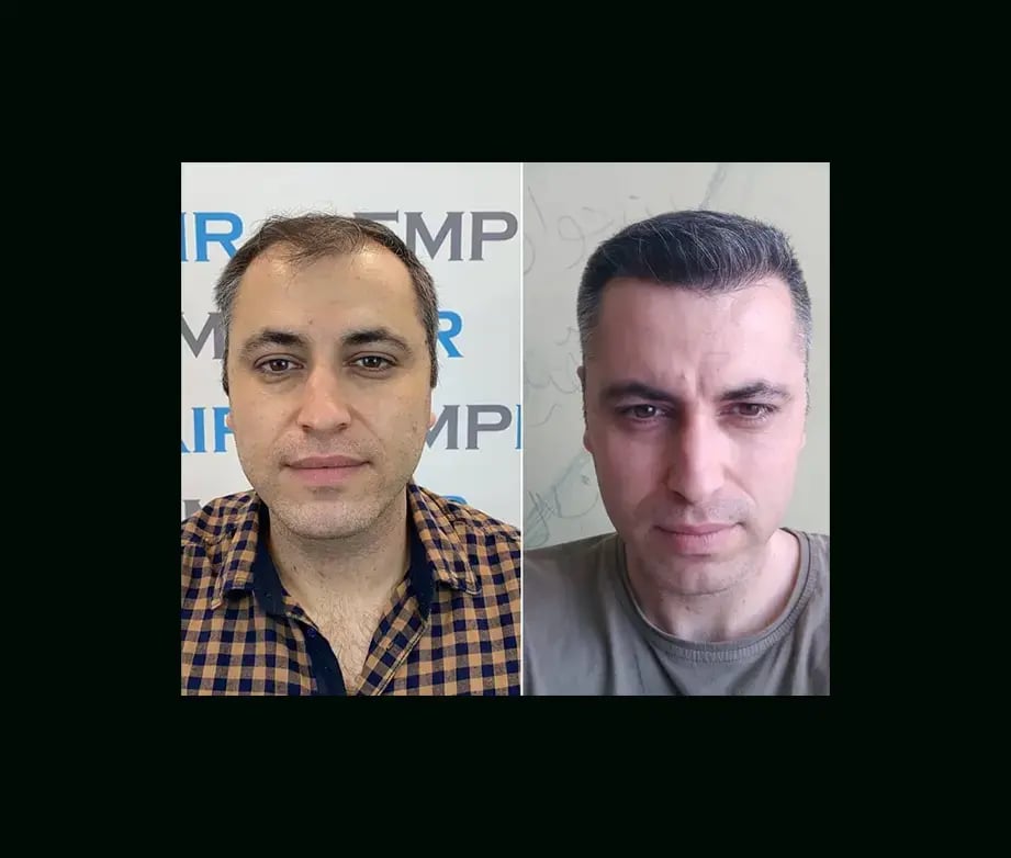 emphair-hair-transplant-before-after-33
