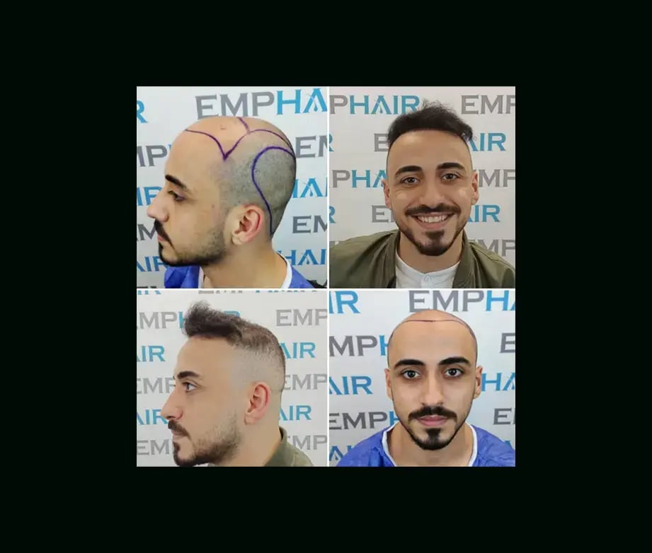emphair-hair-transplant-before-after-34