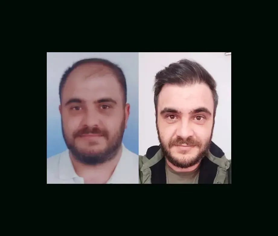 emphair-hair-transplant-before-after-35