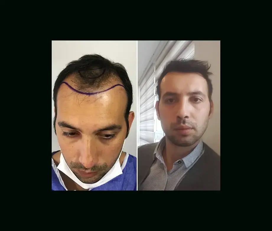emphair-hair-transplant-before-after-36