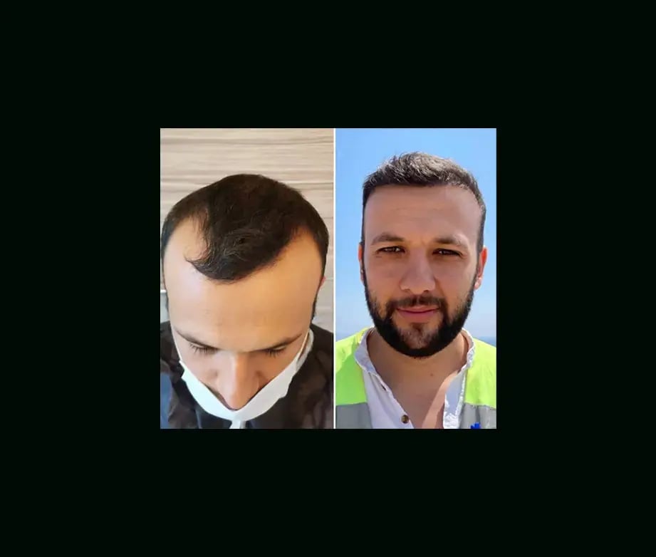 emphair-hair-transplant-before-after-37