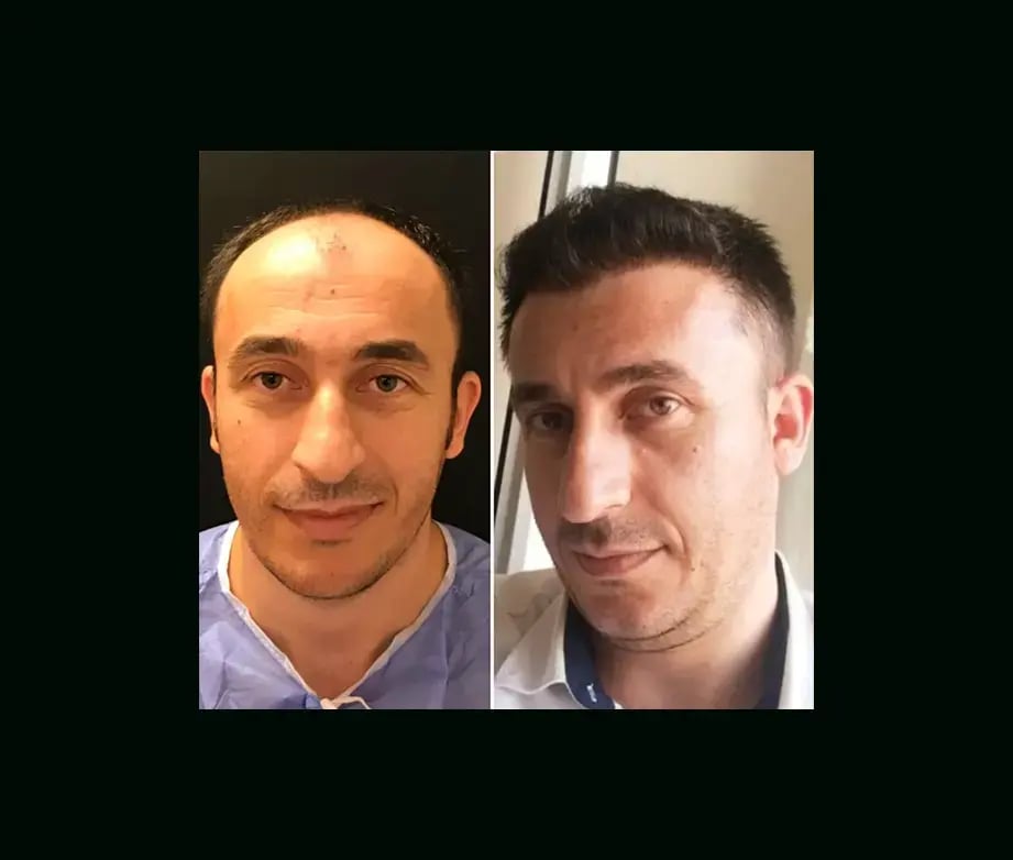 emphair-hair-transplant-before-after-38
