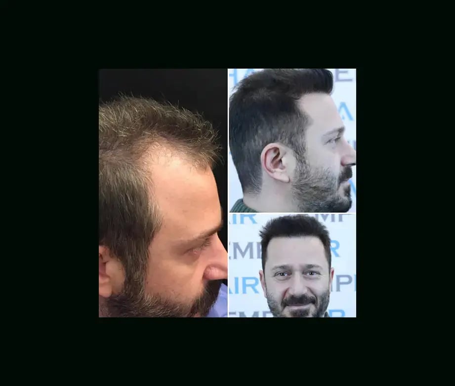 emphair-hair-transplant-before-after-39