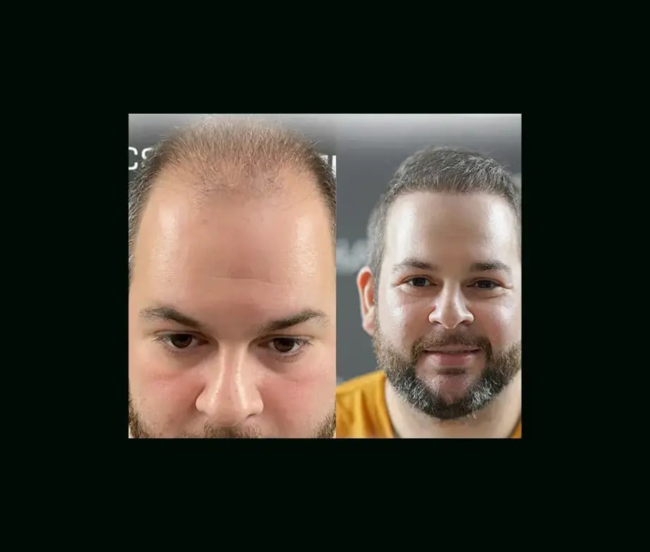 emphair-hair-transplant-before-after-4
