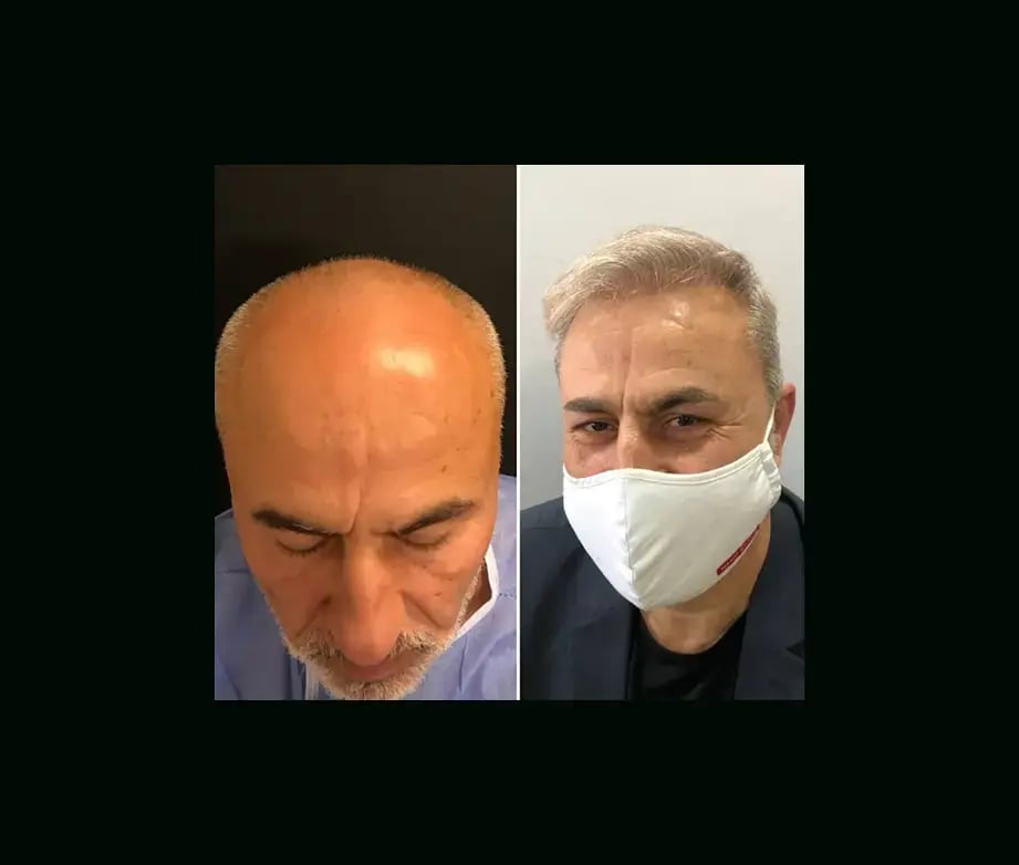 emphair-hair-transplant-before-after-40