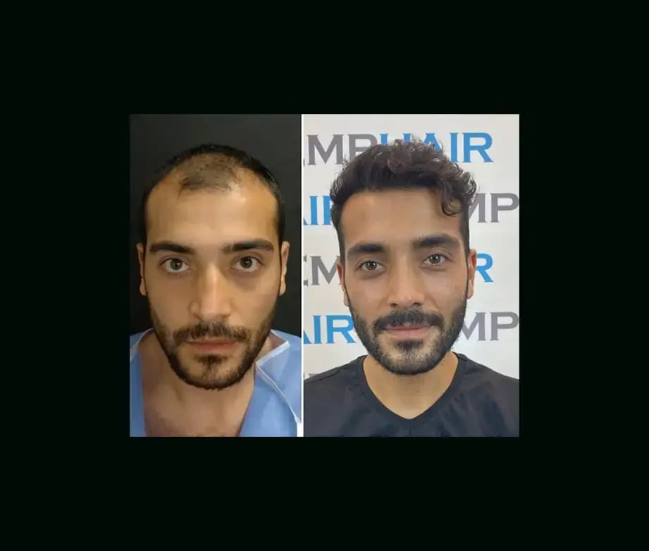 emphair-hair-transplant-before-after-41