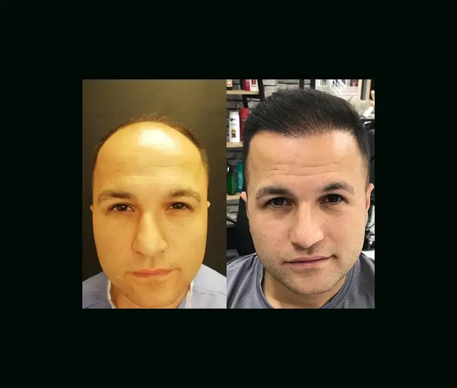 emphair-hair-transplant-before-after-42