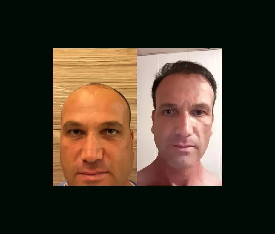 emphair-hair-transplant-before-after-43