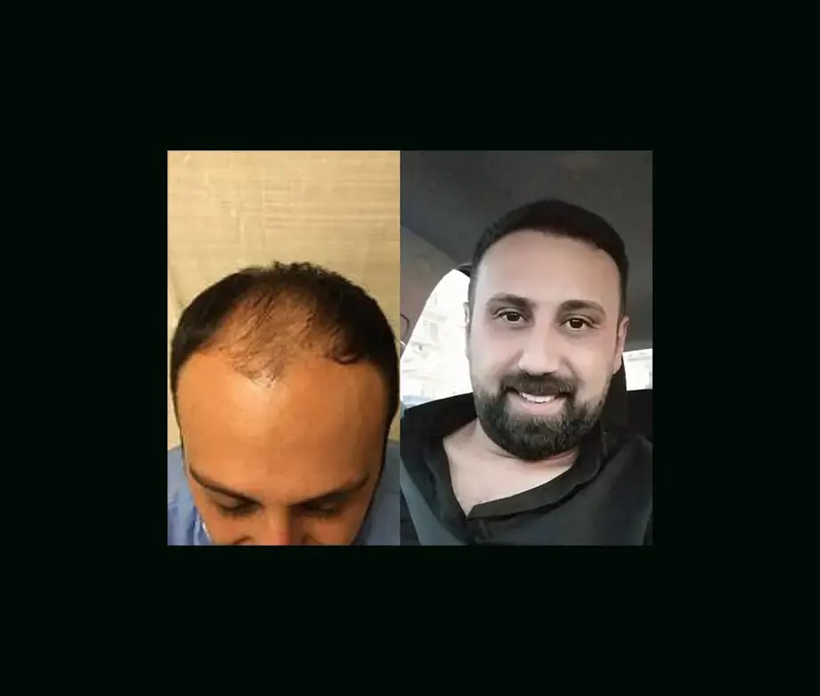 emphair-hair-transplant-before-after-44