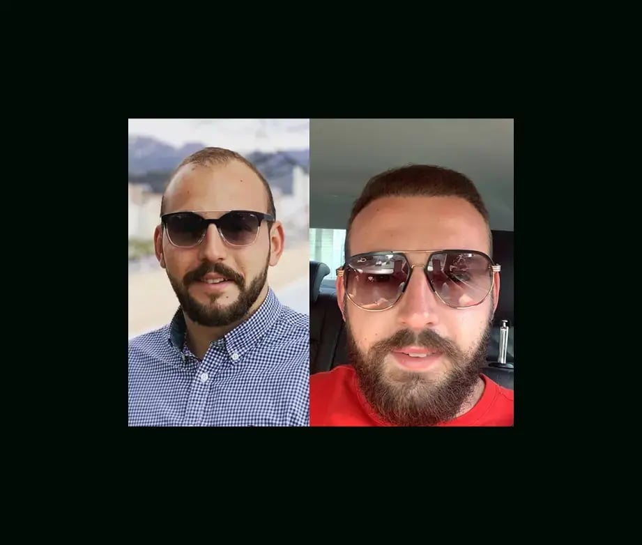 emphair-hair-transplant-before-after-45