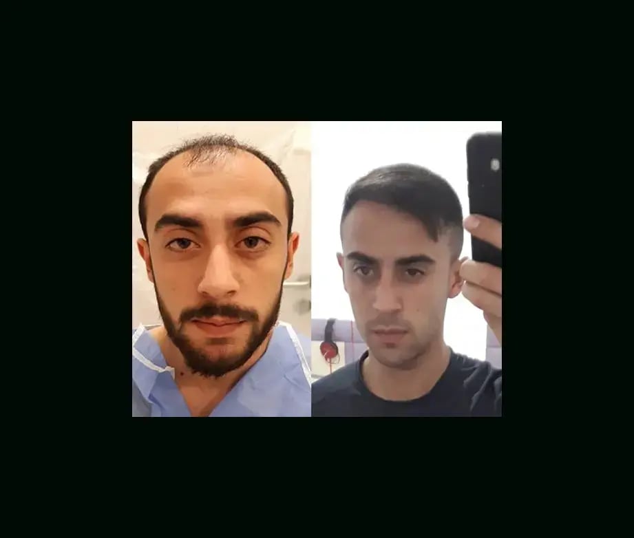 emphair-hair-transplant-before-after-46