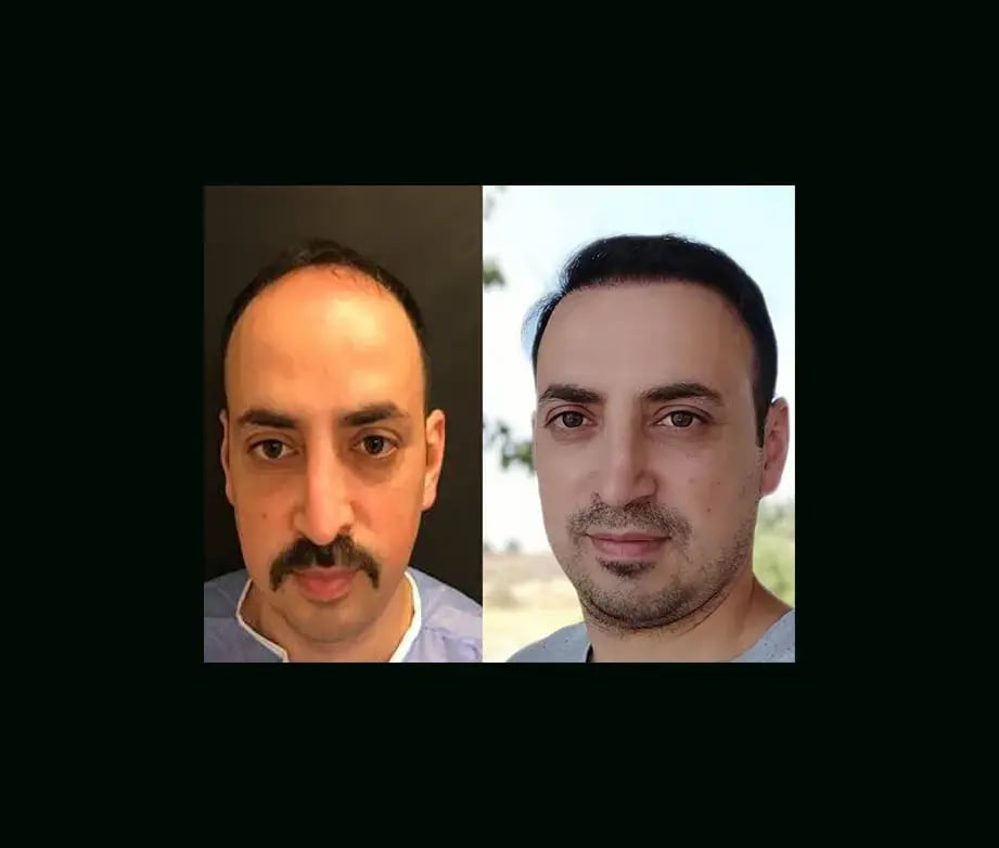 emphair-hair-transplant-before-after-47