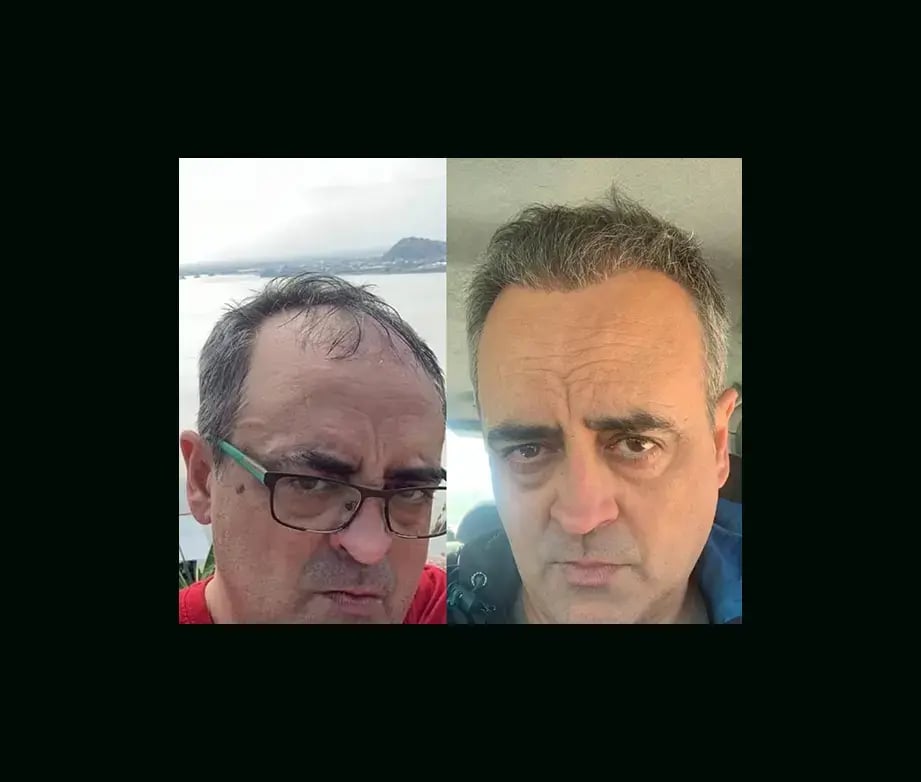 emphair-hair-transplant-before-after-48