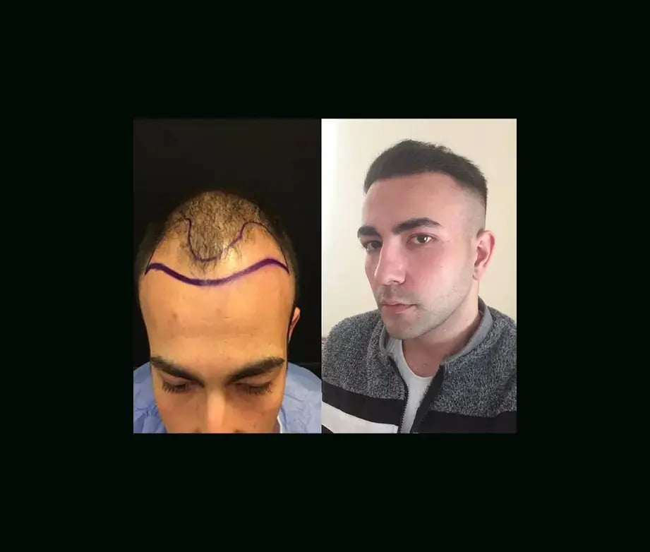 emphair-hair-transplant-before-after-49