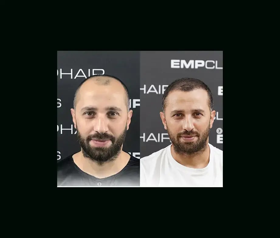 emphair-hair-transplant-before-after-5