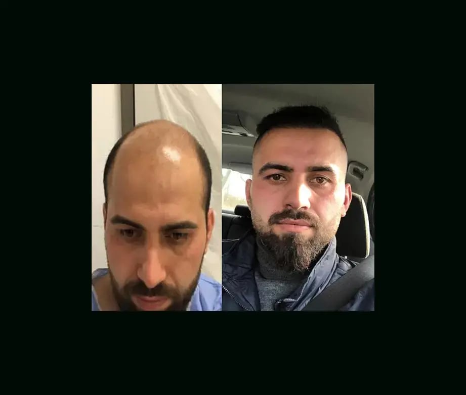 emphair-hair-transplant-before-after-50