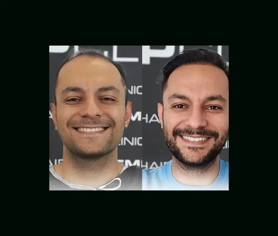 emphair-hair-transplant-before-after-6