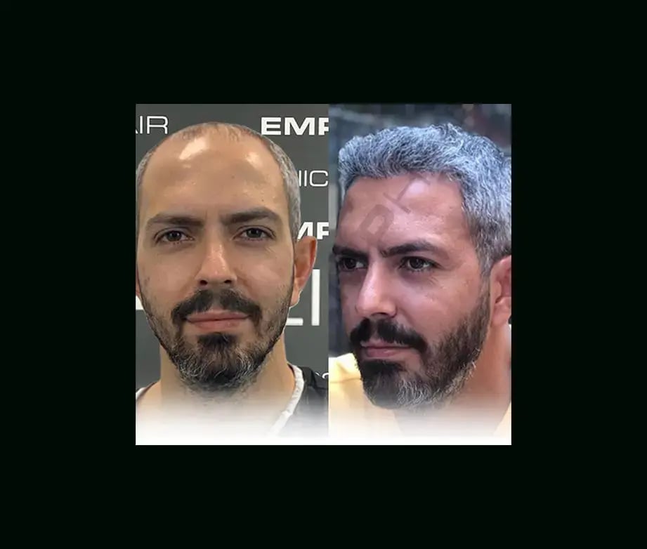 emphair-hair-transplant-before-after-7