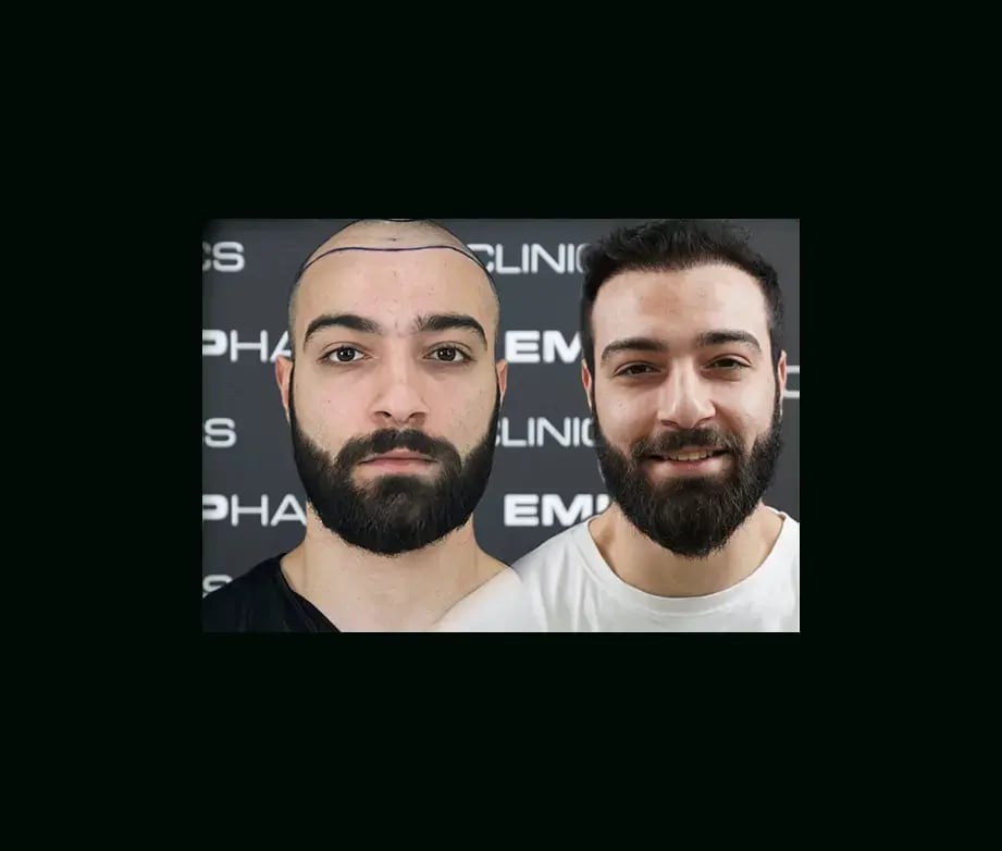 emphair-hair-transplant-before-after-8