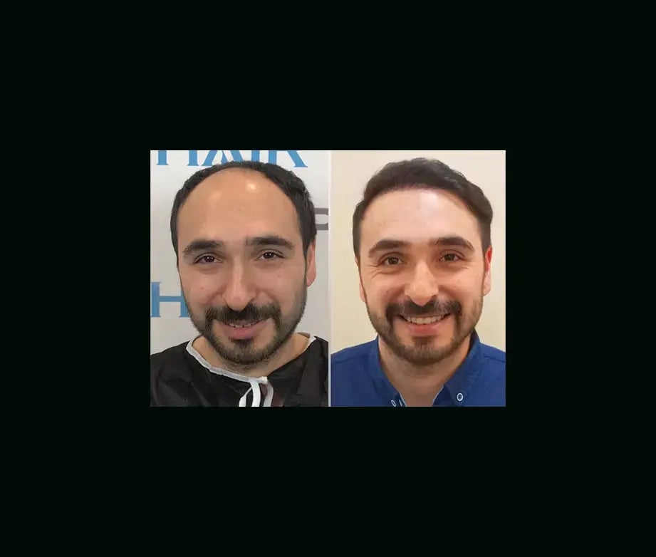 emphair-hair-transplant-before-after-9